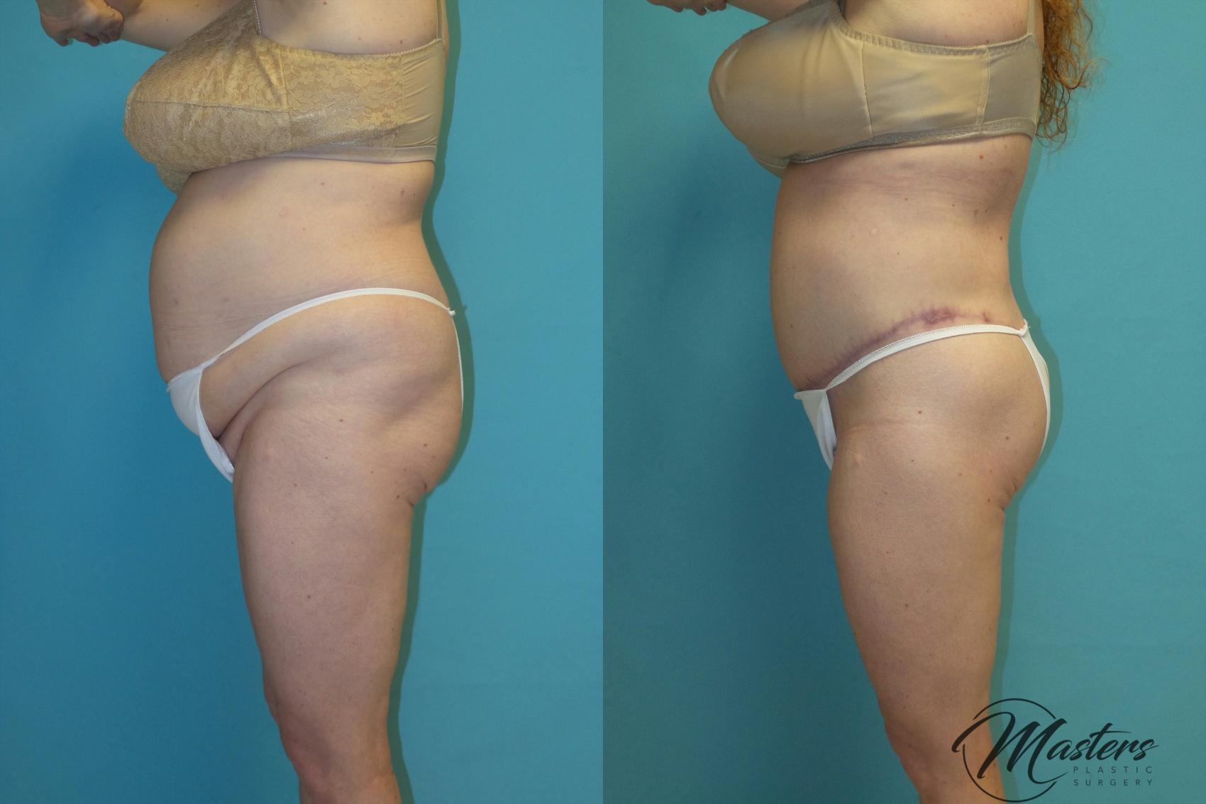 Before & After Tummy Tuck Case 14 Left Side View in Oklahoma City, Tulsa, Norman, OK
