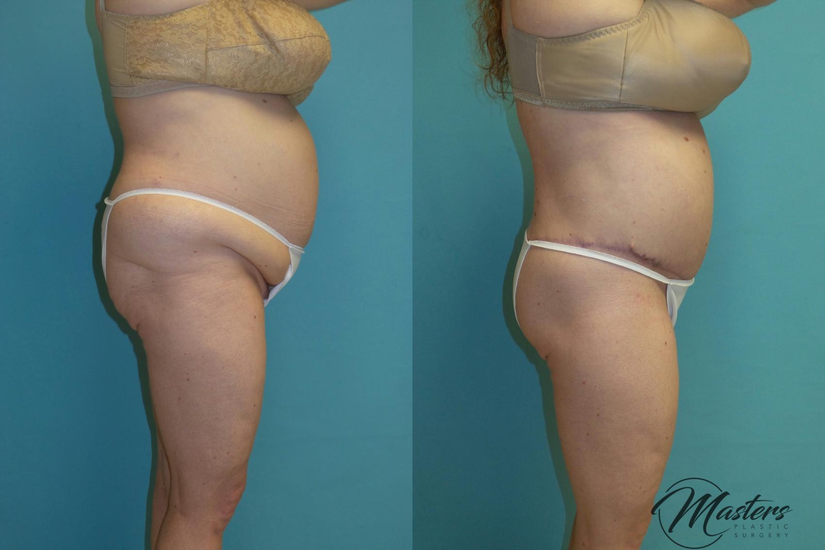 Before & After Tummy Tuck Case 14 Right Side View in Oklahoma City, Tulsa, Norman, OK