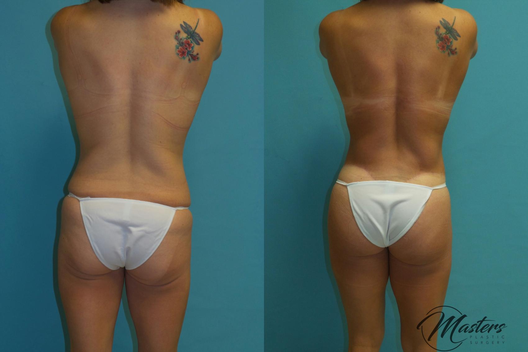 Before & After Tummy Tuck Case 15 Back View in Oklahoma City, Tulsa, Norman, OK