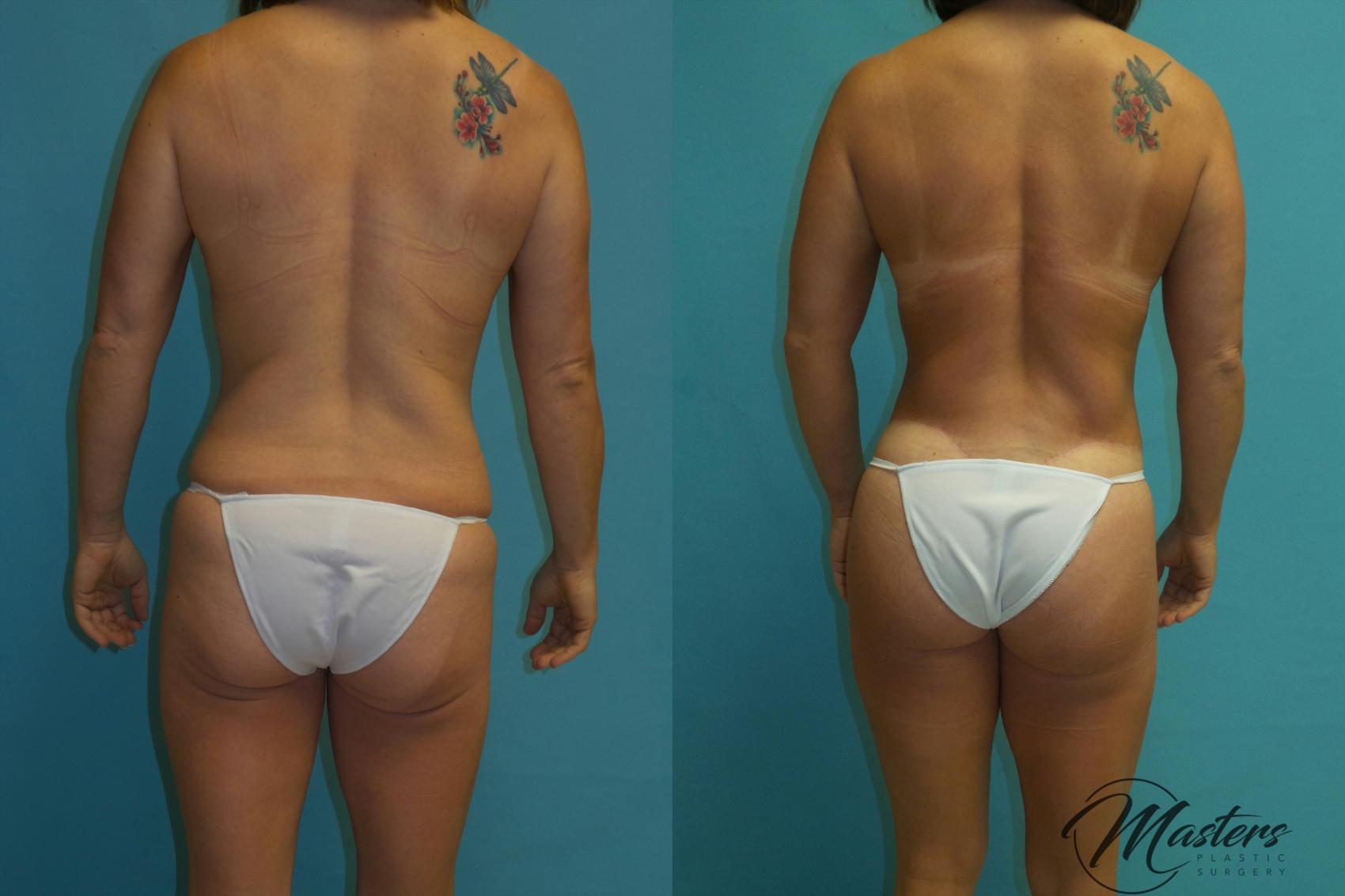 Before & After Tummy Tuck Case 15 Back (Relaxed) View in Oklahoma City, Tulsa, Norman, OK