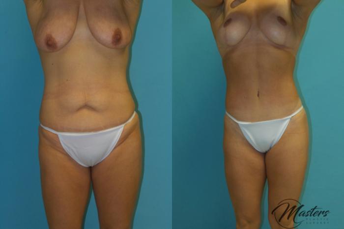 Before & After Tummy Tuck Case 15 Front View in Oklahoma City, Tulsa, Norman, OK
