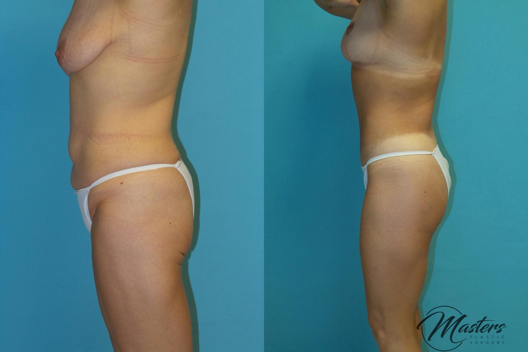 Before & After Tummy Tuck Case 15 Left Side View in Oklahoma City, Tulsa, Norman, OK