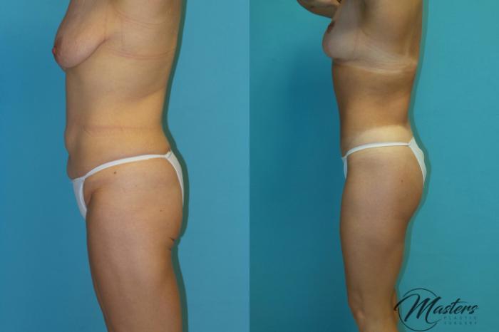 Before & After Tummy Tuck Case 15 Left Side View in Oklahoma City, Tulsa, Norman, OK