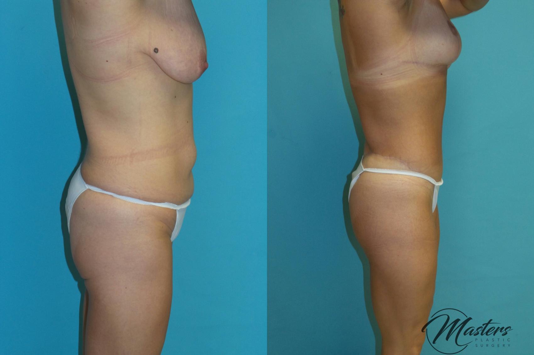 Before & After Tummy Tuck Case 15 Right Side View in Oklahoma City, Tulsa, Norman, OK