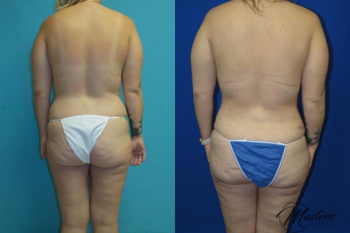 Before & After Tummy Tuck Case 16 Back View in Oklahoma City, Tulsa, Norman, OK