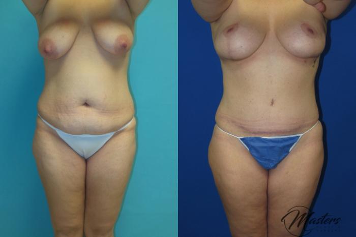 Before & After Tummy Tuck Case 16 Front View in Oklahoma City, Tulsa, Norman, OK