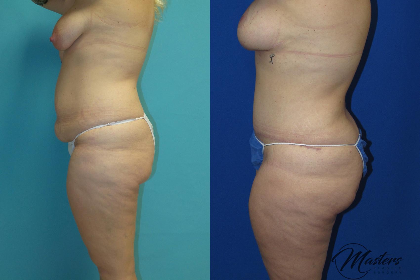 Before & After Tummy Tuck Case 16 Left Side View in Oklahoma City, Tulsa, Norman, OK