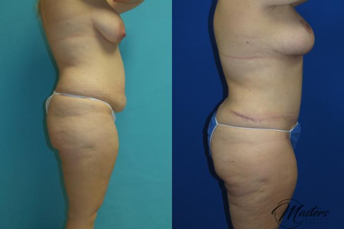 Before & After Tummy Tuck Case 16 Right Side View in Oklahoma City, Tulsa, Norman, OK