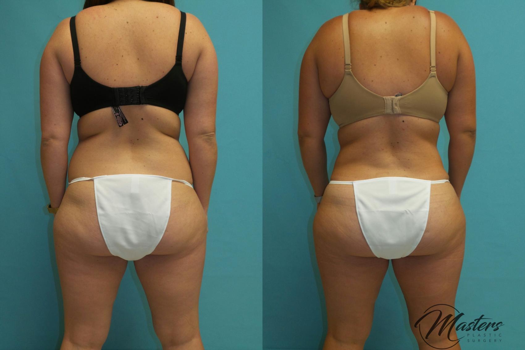 Before & After Tummy Tuck Case 17 Back View in Oklahoma City, Tulsa, Norman, OK