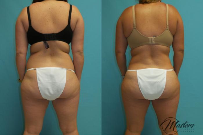 Tummy Tuck Before and After Pictures Case 17