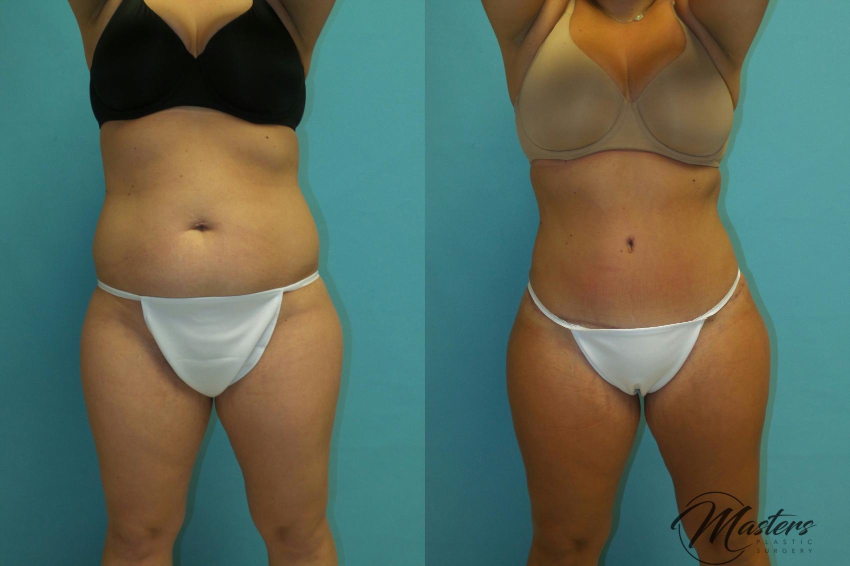 Before & After Tummy Tuck Case 17 Front View in Oklahoma City, Tulsa, Norman, OK