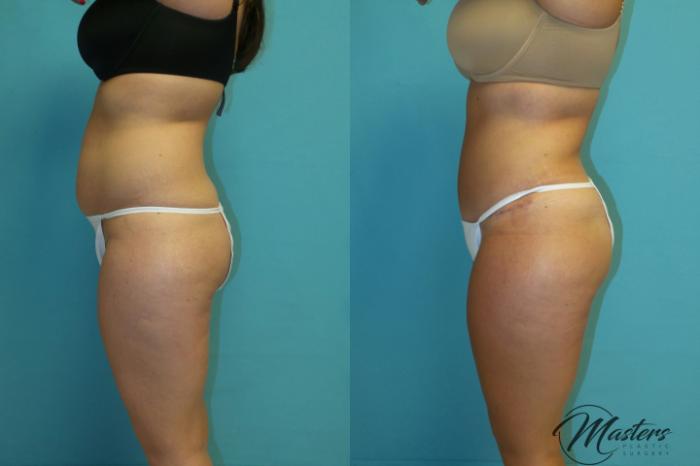 Before & After Tummy Tuck Case 17 Left Side View in Oklahoma City, Tulsa, Norman, OK