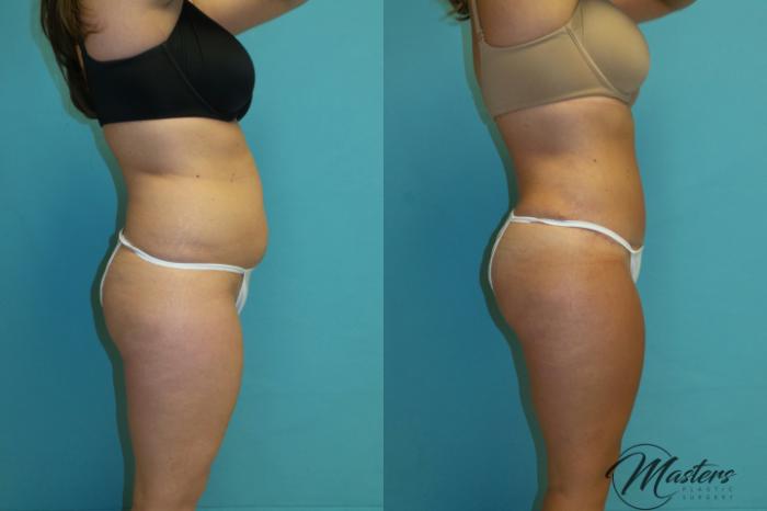 Before & After Tummy Tuck Case 17 Right Side View in Oklahoma City, Tulsa, Norman, OK