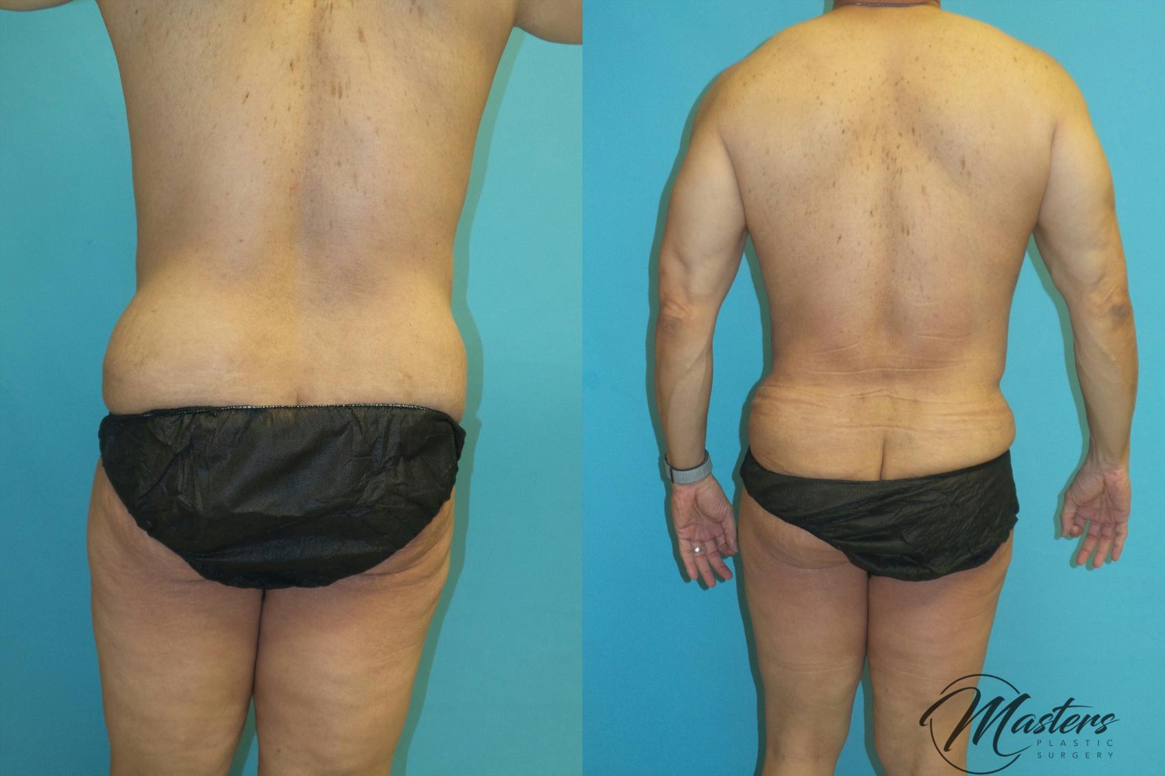 Before & After Tummy Tuck Case 18 Back View in Oklahoma City, Tulsa, Norman, OK