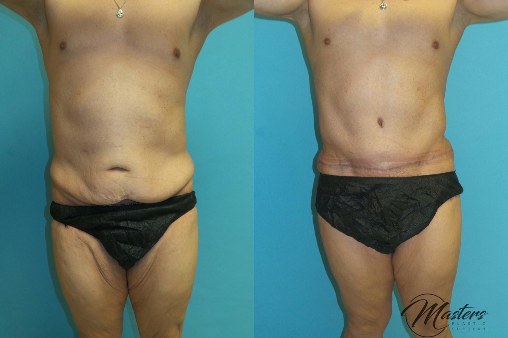 Before & After Tummy Tuck Case 18 Front View in Oklahoma City, Tulsa, Norman, OK