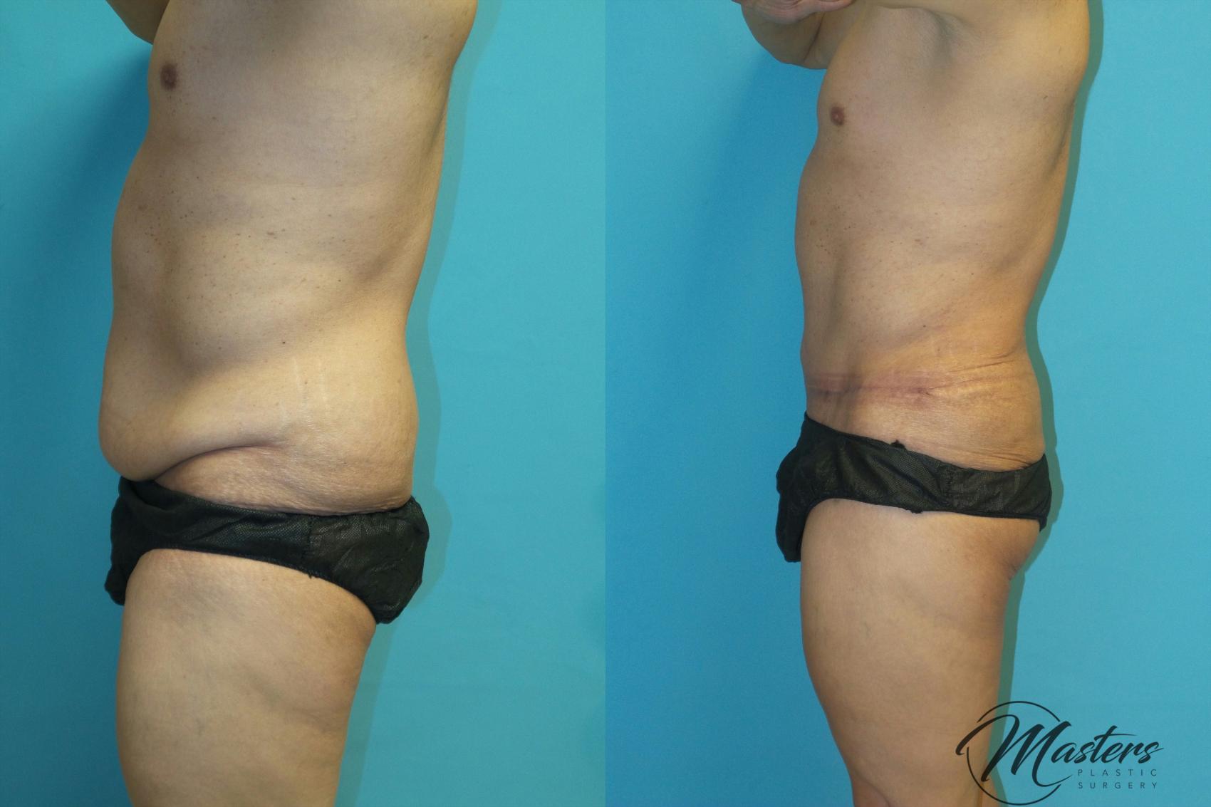 Before & After Tummy Tuck Case 18 Left Side View in Oklahoma City, Tulsa, Norman, OK