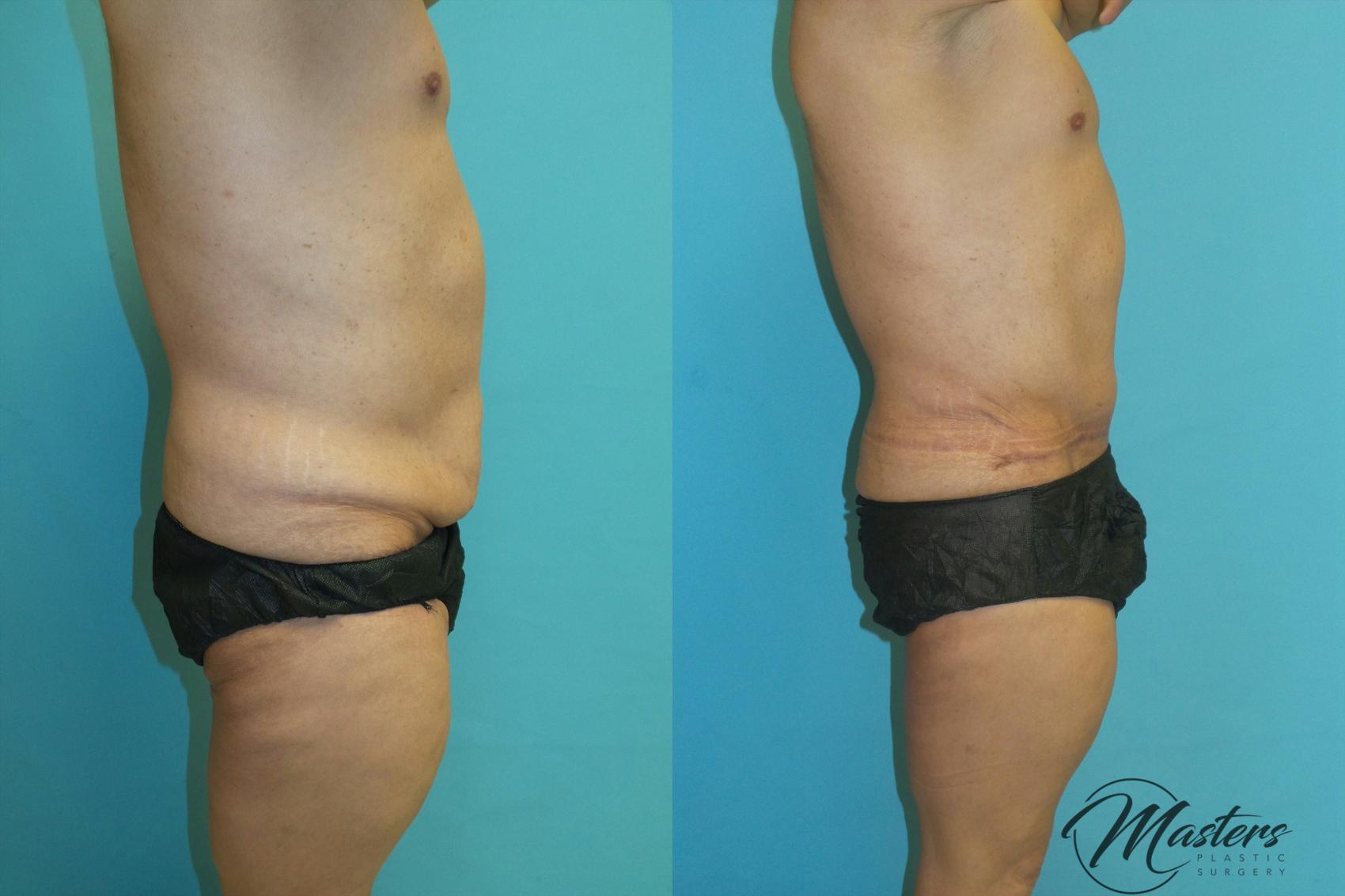 Before & After Tummy Tuck Case 18 Right Side View in Oklahoma City, Tulsa, Norman, OK