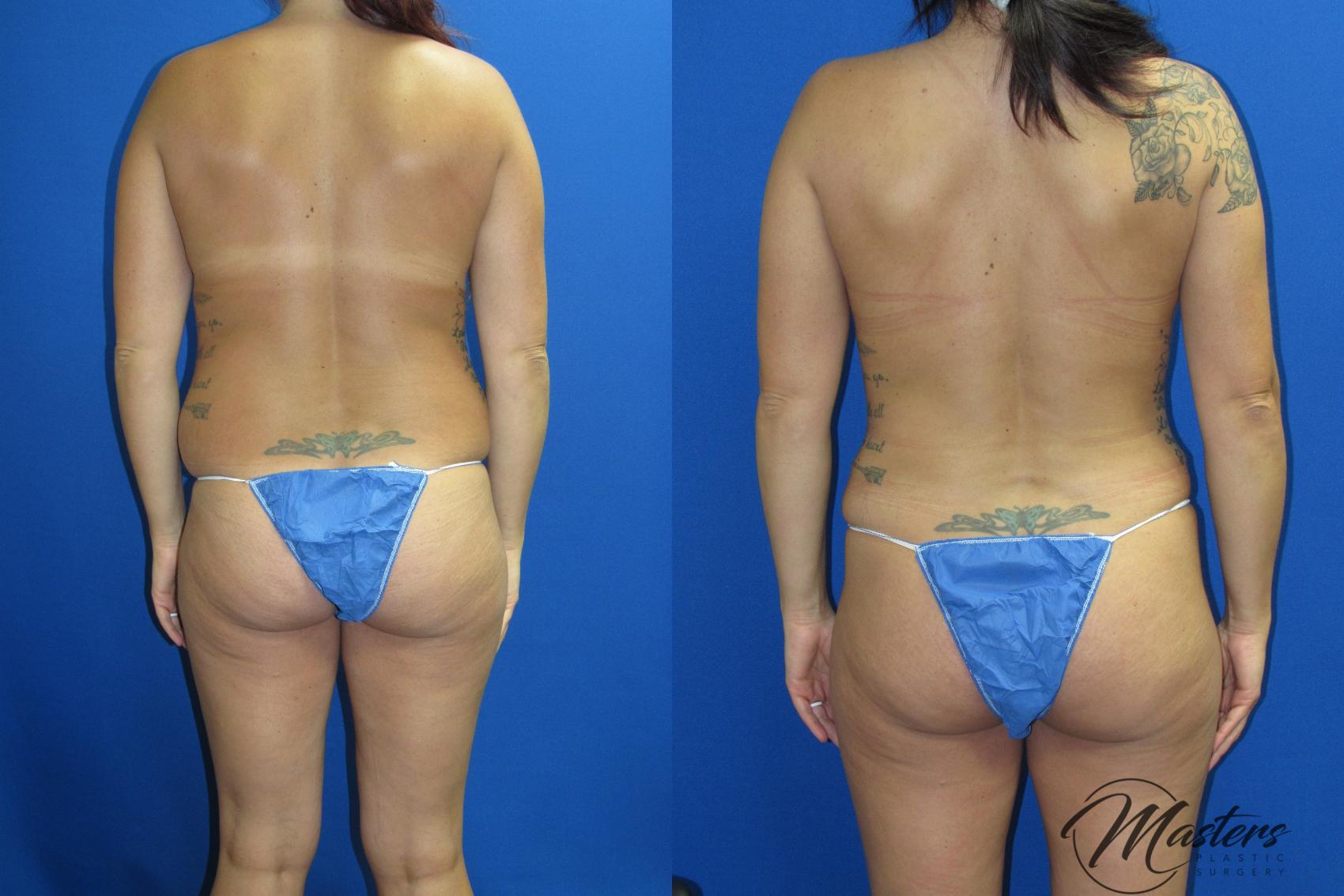 Before & After Tummy Tuck Case 19 Back View in Oklahoma City, Tulsa, Norman, OK