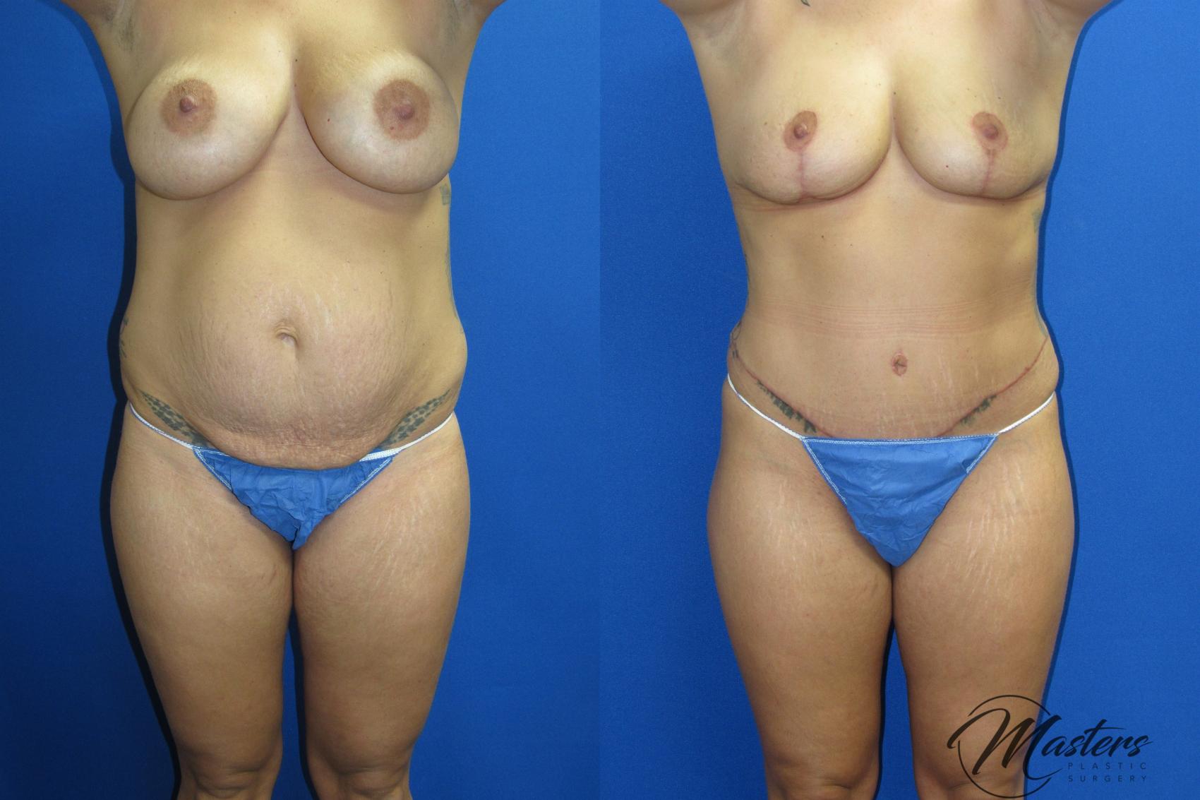 Before & After Tummy Tuck Case 19 Front View in Oklahoma City, Tulsa, Norman, OK
