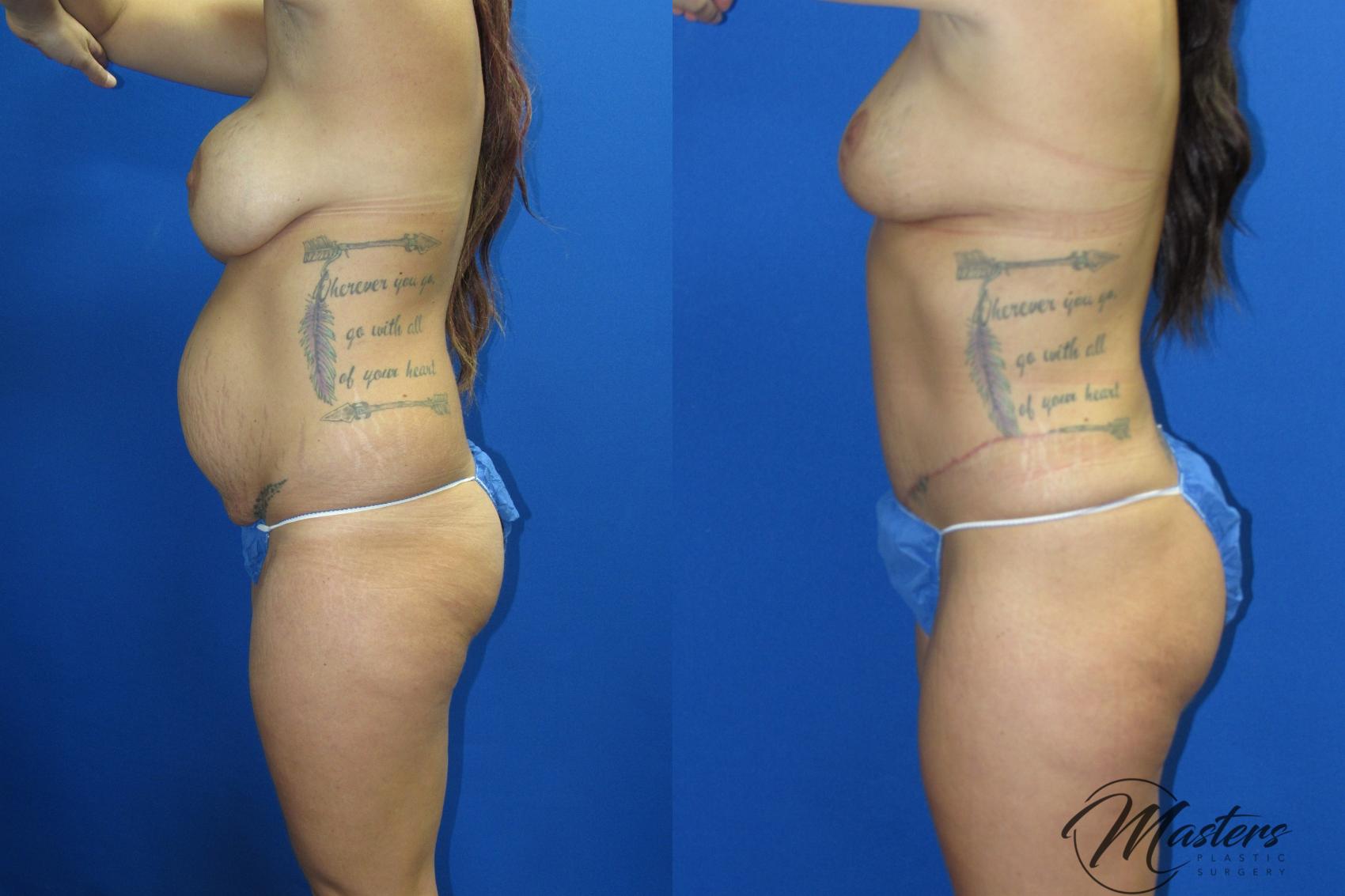 Before & After Tummy Tuck Case 19 Left Side View in Oklahoma City, Tulsa, Norman, OK