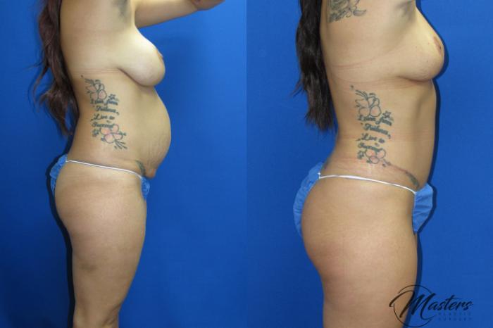 Before & After Tummy Tuck Case 19 Right Side View in Oklahoma City, Tulsa, Norman, OK
