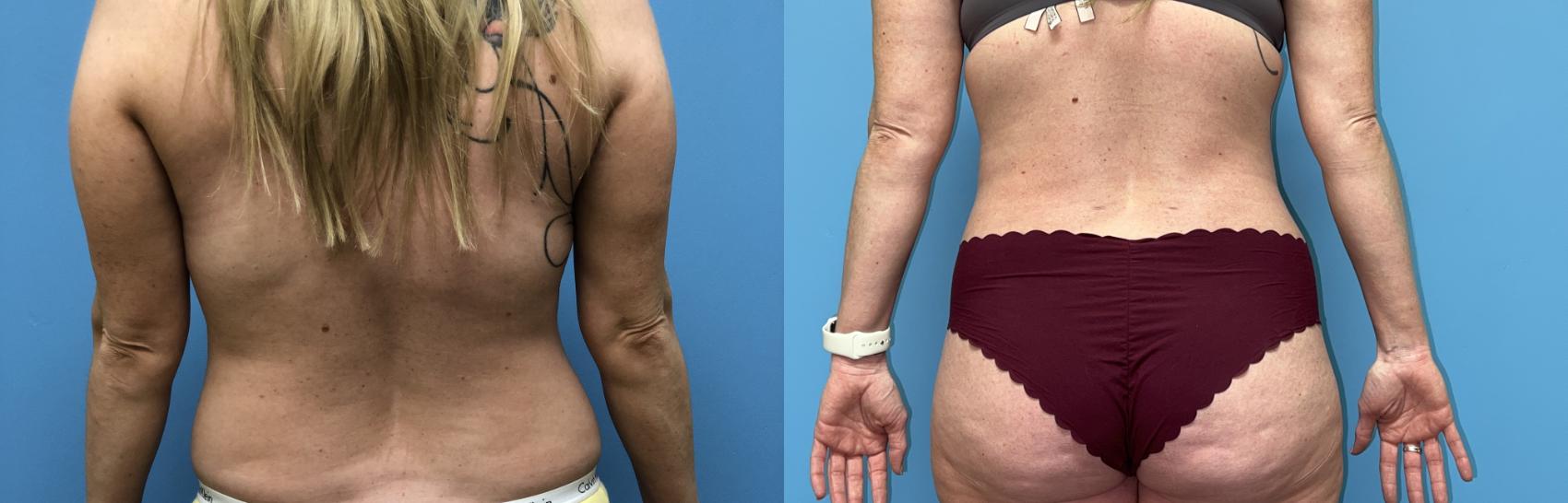 Before & After Tummy Tuck Case 23 Back View in Oklahoma City, Tulsa, Norman, OK