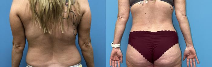 Before & After Tummy Tuck Case 23 Back View in Oklahoma City, Tulsa, Norman, OK
