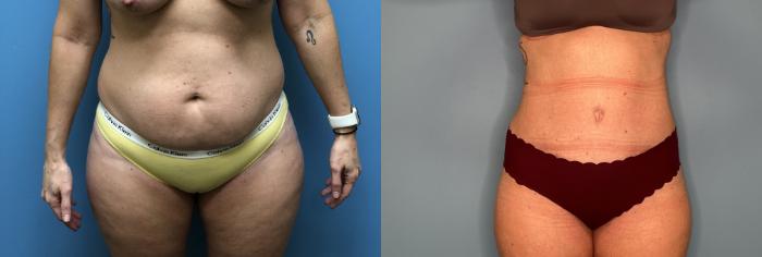 Before & After Tummy Tuck Case 23 Front View in Oklahoma City, Tulsa, Norman, OK