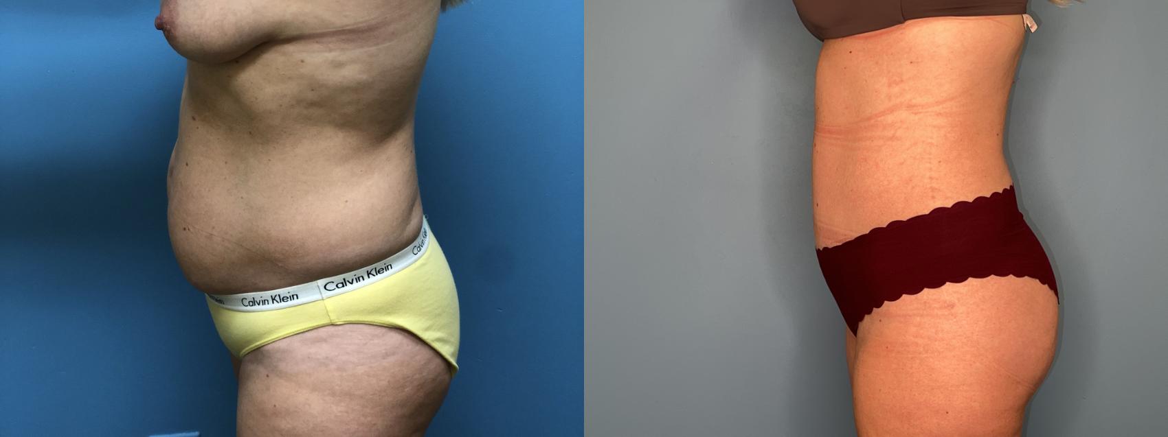 Before & After Tummy Tuck Case 23 Left Side View in Oklahoma City, Tulsa, Norman, OK