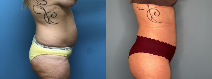 Before & After Tummy Tuck Case 23 Right Side View in Oklahoma City, Tulsa, Norman, OK