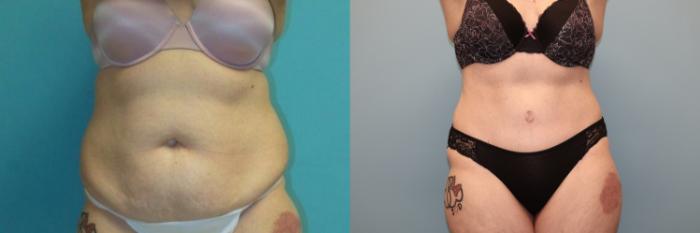 Before & After Tummy Tuck Case 24 Front View in Oklahoma City, Tulsa, Norman, OK