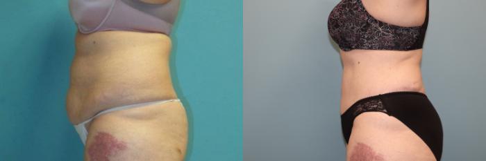 Before & After Tummy Tuck Case 24 Left Side View in Oklahoma City, Tulsa, Norman, OK