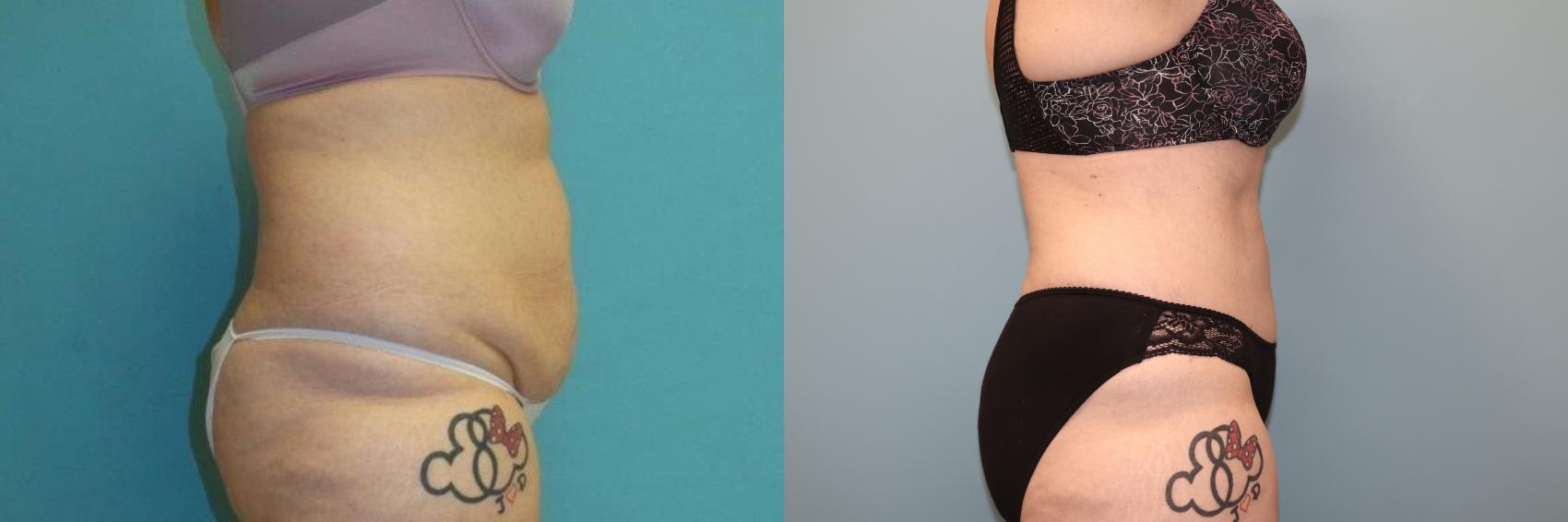 Before & After Tummy Tuck Case 24 Right Side View in Oklahoma City, Tulsa, Norman, OK
