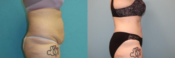 Before & After Tummy Tuck Case 24 Right Side View in Oklahoma City, Tulsa, Norman, OK