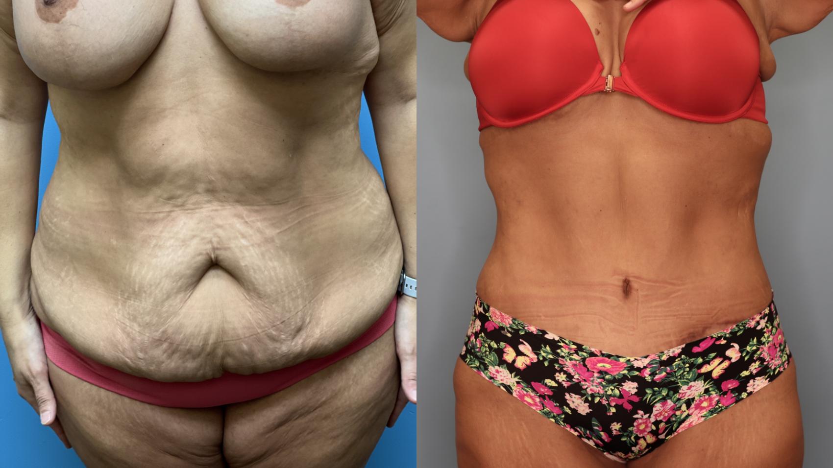 Before & After Tummy Tuck Case 25 Front View in Oklahoma City, Tulsa, Norman, OK