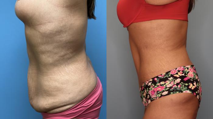 Before & After Tummy Tuck Case 25 Left Side View in Oklahoma City, Tulsa, Norman, OK