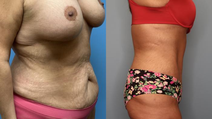 Before & After Tummy Tuck Case 25 Right Side View in Oklahoma City, Tulsa, Norman, OK