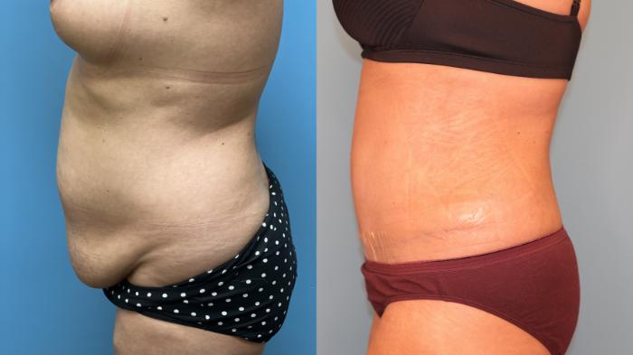 Before & After Tummy Tuck Case 26 Left Side View in Oklahoma City, Tulsa, Norman, OK