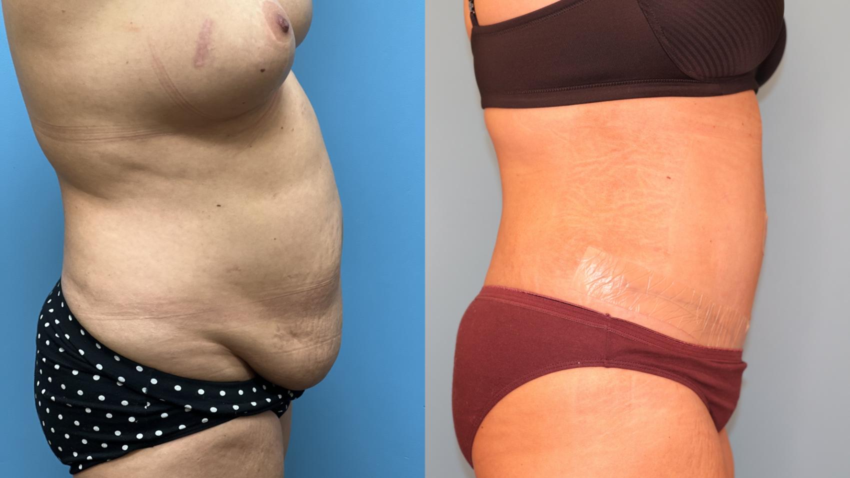 Before & After Tummy Tuck Case 26 Right Side View in Oklahoma City, Tulsa, Norman, OK