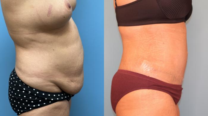 Before & After Tummy Tuck Case 26 Right Side View in Oklahoma City, Tulsa, Norman, OK