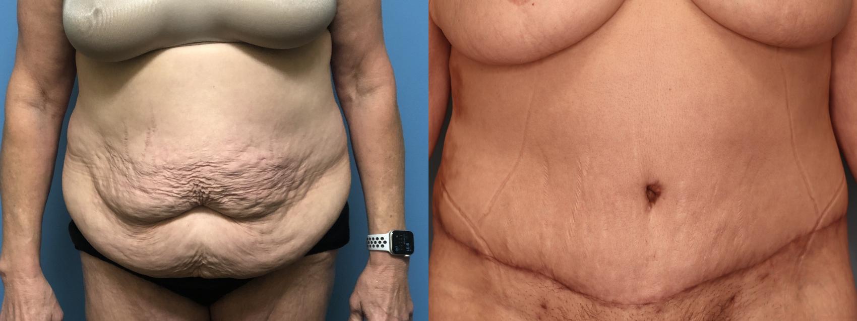 Before & After Tummy Tuck Case 29 Front View in Oklahoma City, Tulsa, Norman, OK