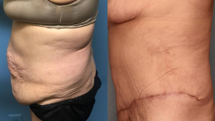 Before & After Tummy Tuck Case 29 Left Side View in Oklahoma City, Tulsa, Norman, OK