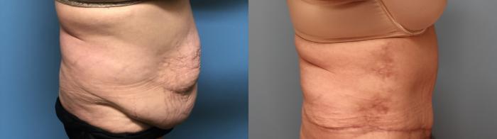 Before & After Tummy Tuck Case 29 Right Side View in Oklahoma City, Tulsa, Norman, OK