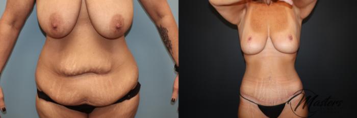 Mommy Makeover Breast Lift Breast Augmentation Tummy tuck