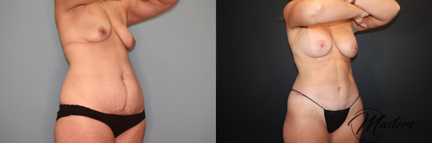 Mommy Makeover Breast Lift Breast Augmentation Tummy tuck
